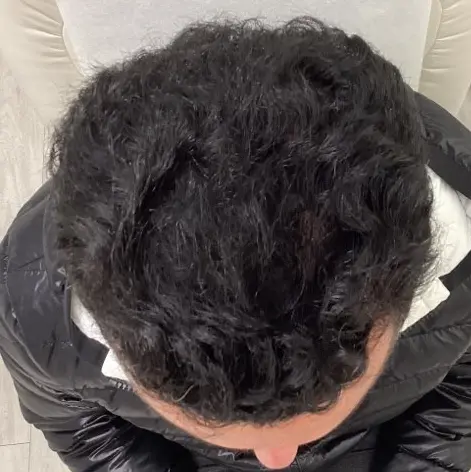 Spectrum Dermatology patients hair after PRFM treatments