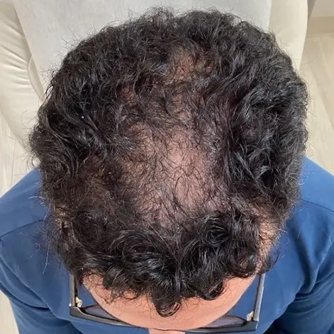 Spectrum Dermatology patients hair before PRFM treatments