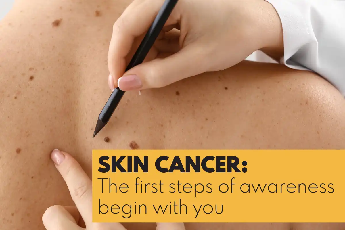 Skin Cancer: The first steps of awareness begin with you
